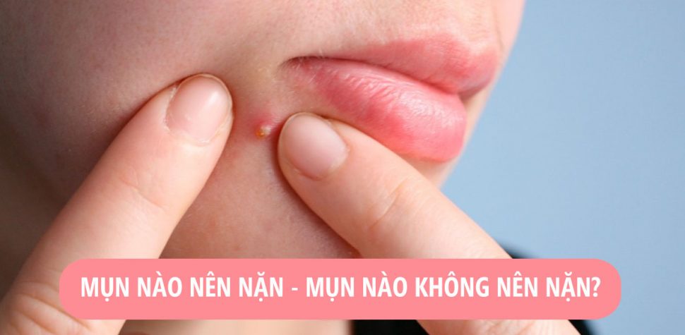 Những loại mụn tuyệt đối không nên nặn nếu không muốn da tổn thương